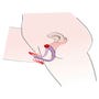 Ecarteur de Vagin et Stimulateur de Point G Intimate Spreader